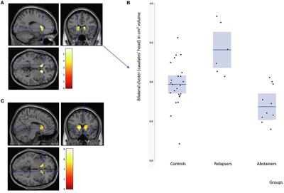 Caudate gray matter volumes and risk of relapse in Type A alcohol-dependent patients: A 7-year MRI follow-up study